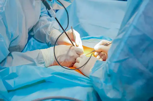 TOTAL LAPAROSCOPIC HYSTERECTOMY