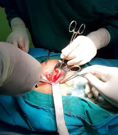 LAPROSCOPIC APPENDECTOMY IN YELAHANKA